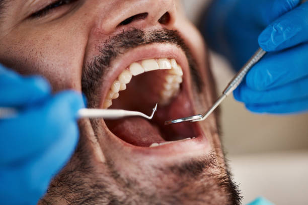 Best Emergency Wisdom Tooth Extraction in Ste Genevieve, MO