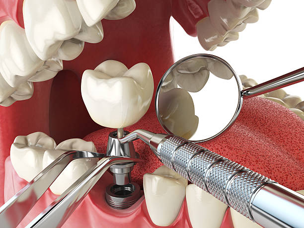 Best Knocked-Out Tooth (Avulsed Tooth) Treatment in Ste Genevieve, MO